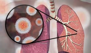 hepatitice